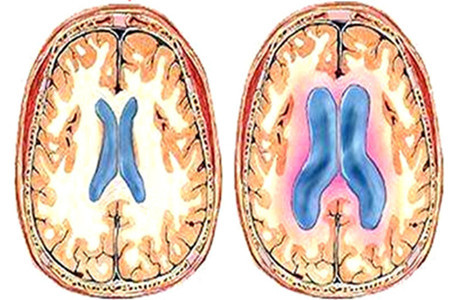 脑积水脑室⁃腹腔分流术后帕金森综合征三例临床分析